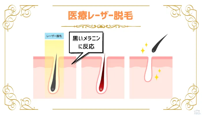 永久脱毛とは？メカニズムや種類、メリット・デメリットを徹底解説 