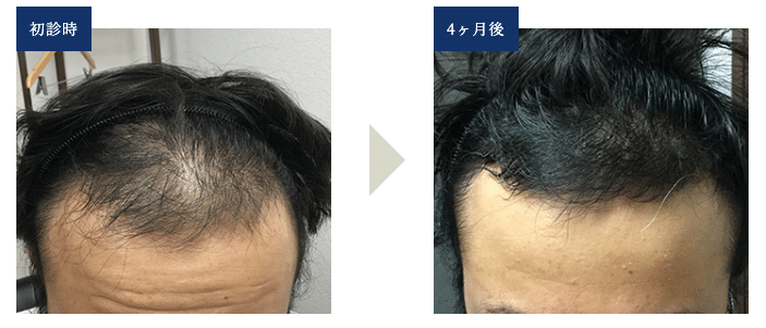 AGA治療25歳ビフォーアフタ(AGAメディカルクリニック)