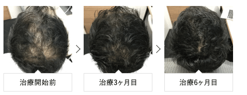 AGA治療ビフォーアフタ(AGAヘアクリニック)