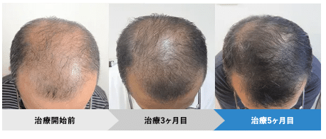 AGA治療経過ビフォーアフタ（AGAヘアクリニック）
