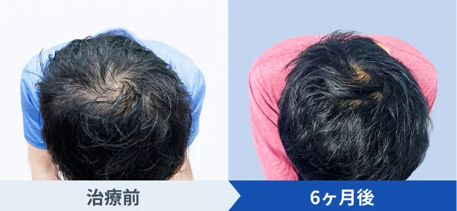 軽度の方40代後半のAGA治療前後症例