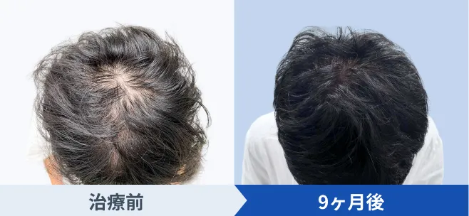 軽度の方30代後半のAGA治療前後症例