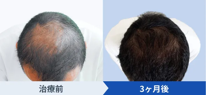 中等度の方40代後半のAGA治療前後症例