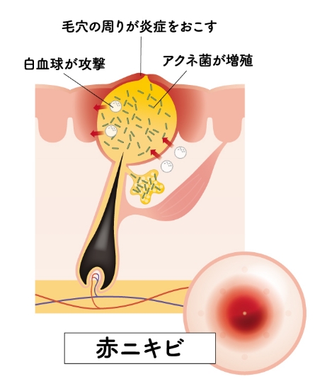 ニキビ・ニキビ跡について
