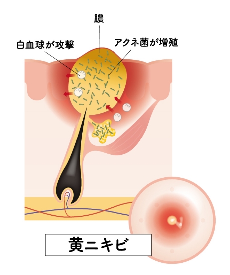 ニキビ・ニキビ跡について