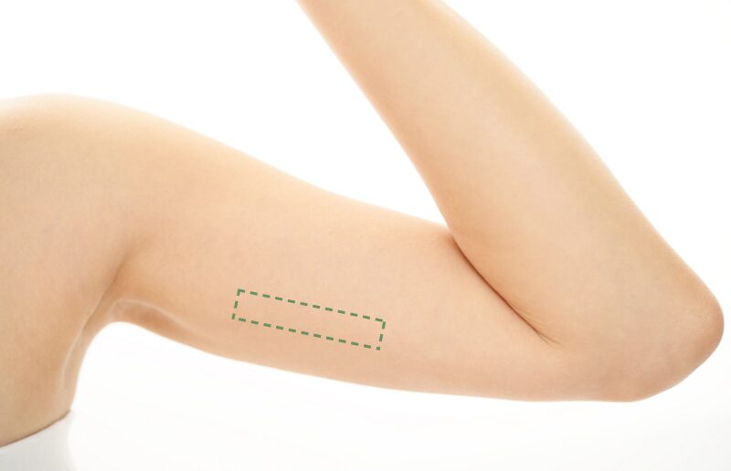 避妊インプラントとは